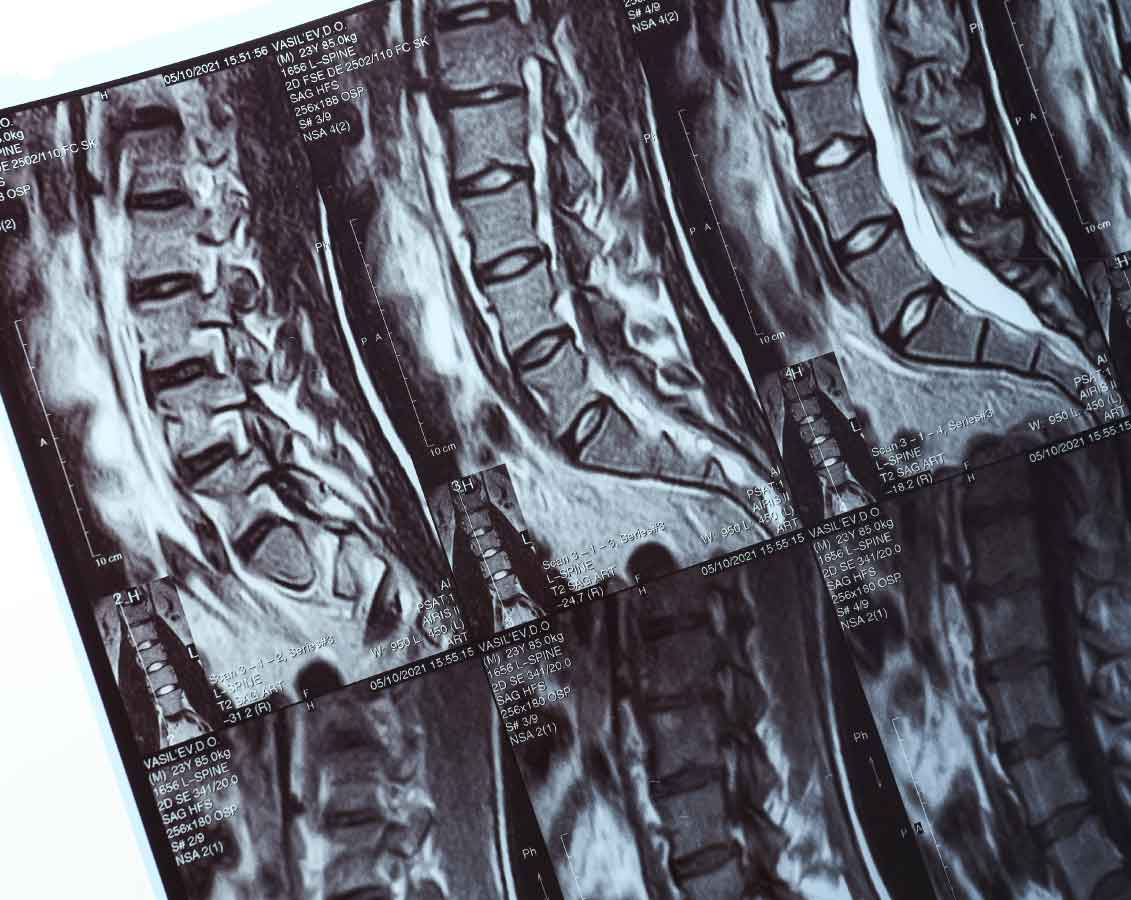 Artículo sobre fisioterapia preventiva y salud lumbar