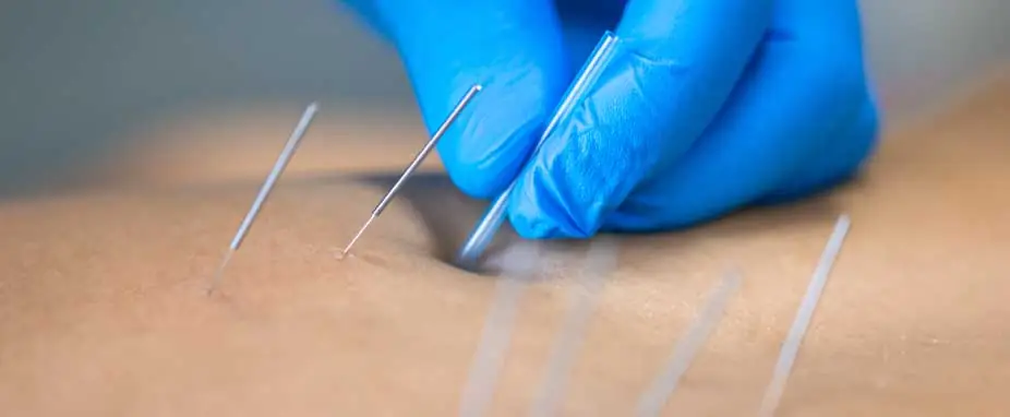 Tratamiento de punción seca en Kinetria